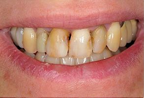 All Smiles Dental Care | Oral Cancer Screening, Dentures and Teeth Whitening